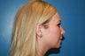 Radiesse for chin augmentation