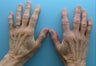 Hand Rejuventation