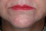 Radiesse and Botox
