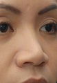 Non-Surgical Rhinoplasty