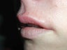 Restylane for upper lip