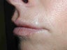 Restylane in Upper Lip