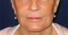 Restylane injection into lips and nasolabial folds