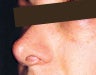 Injectables