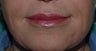 Lip Augmentation with Restylane