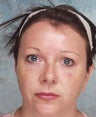 Microdroplet BOTOX® and Deepfill Restylane®