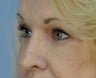 Restylane under Eyes