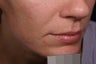 Restylane