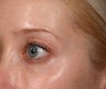 Restylane under eyes