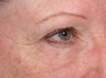 Resytlane under eyes