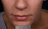 Restylane