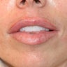 Uneven Lips Before and After Restylane