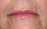 Restylane injection to nasolabial folds