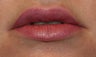 Restylane and botox used to augment the lips