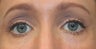 Restylane to tear trough deformity of lower lids