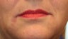 Restylane and Radiesse