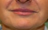 Restylane around the mouth