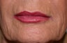 Restylane filler to the lips