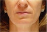 Restylane in Nasolabial folds and Marionette lines
