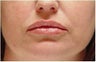 Lip augmentation