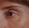 Restylane Injection into the Tear Troughs