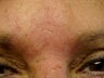 Immediate Improvement of a Forehead Wrinkle