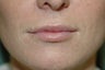 Lip augmentation