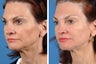 Fillers and Botox Cosmetic