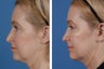 Restylane and Botox Cosmetic