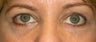 Restylane for eyes