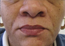 Restylane Injection Nasolabila folds
