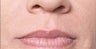 Restylane®