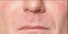 Restylane®