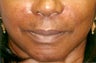 Restylane injection