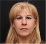 Restylane & Juvederm