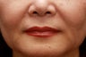 Fill the nasolabial folds and marionette lines