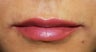 Lip Injection