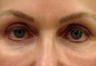 Tear trough filler