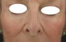 Midface, Cheeks, Tear troughs, and Nasolabial folds treated Restylane and Radiesse