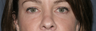 Restylane