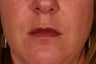 Restylane treatment