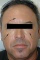 Restylane for dark circles under the eyes