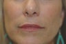 Restylane Treatment for lips