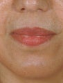 Restylane injections for laugh lines