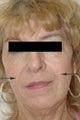 Restylane injections for laugh lines