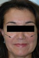 Restylane for laugh lines