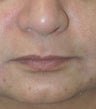 Restylane for marionette (mouth) lines