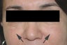 Restylane injections for cheek augmentation