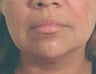 Restylane for laugh lines