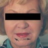 Oral Commissures (marionette lines) with Restylane Treatment